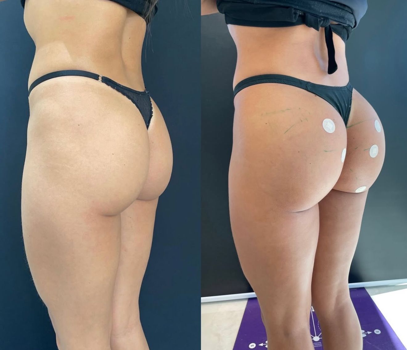 Antes e depois de remodelação glútea em vista lateral